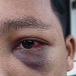 Santri di Muaro Jambi Diduga Dianiaya Oknum Guru hingga Pingsan dan Mata Bengkak