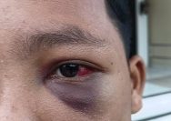 Santri di Muaro Jambi Diduga Dianiaya Oknum Guru hingga Pingsan dan Mata Bengkak